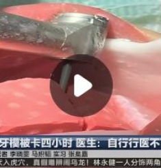 自取牙模被卡四小时 医生：自行行医不可取
